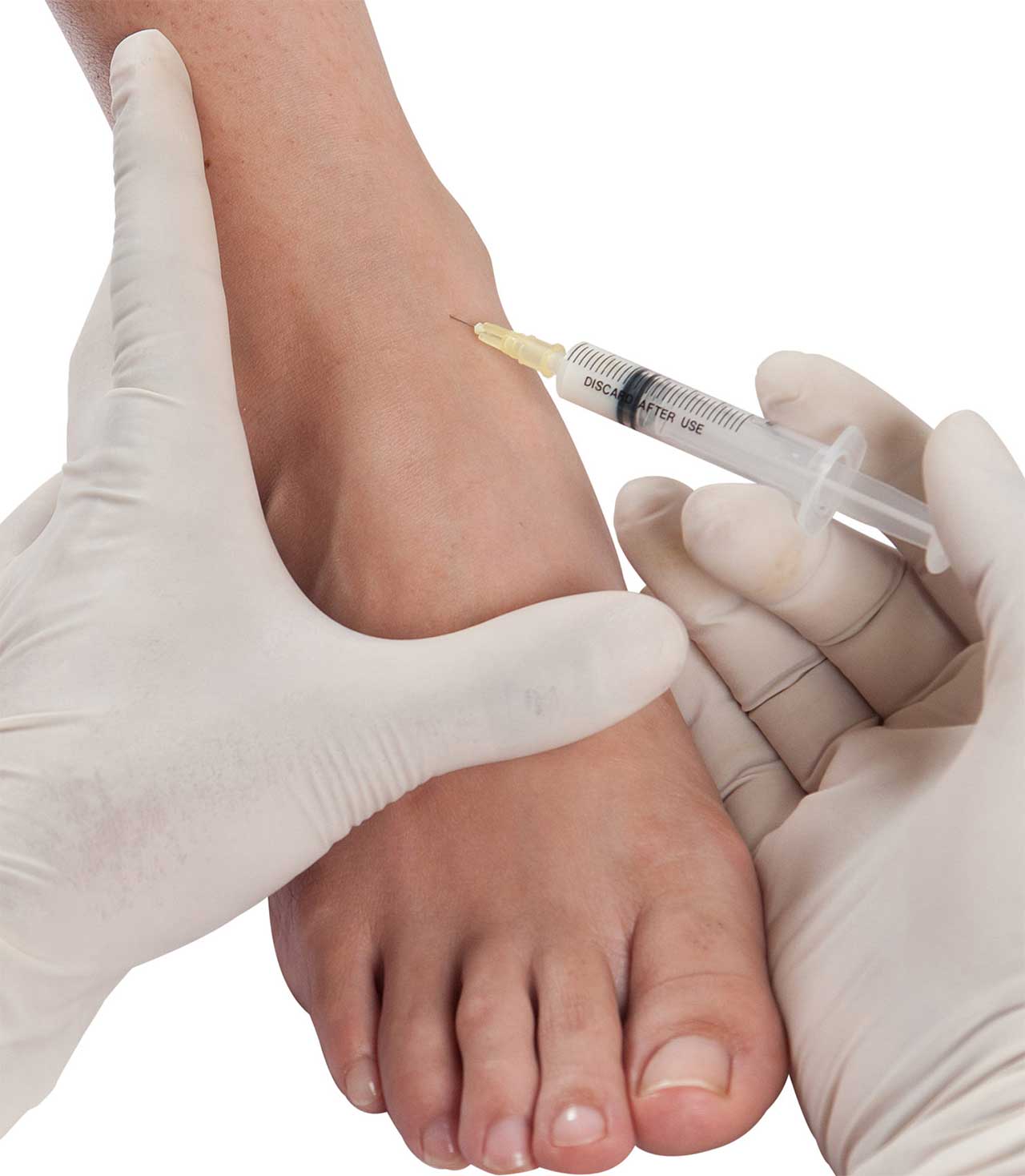 Steroid injection into a foot